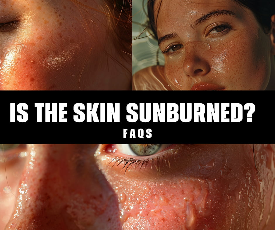 Is it safe to get a tattoo while your skin is sunburned?